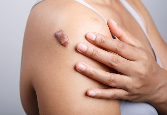Keloid Treatment in Turkey