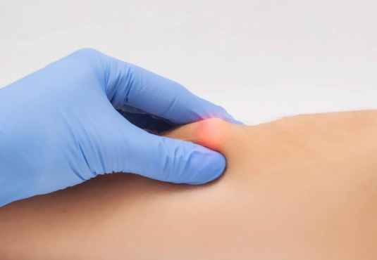 Lipoma Surgery in Turkey