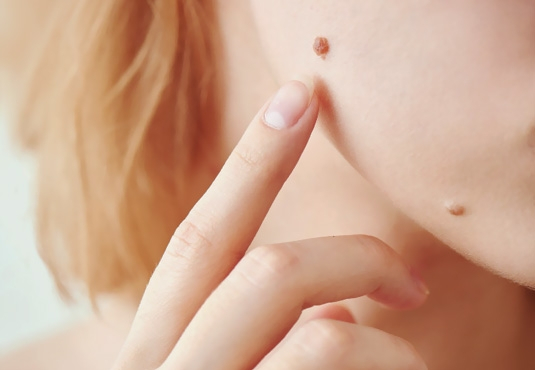 Mole Removal (Nevus Excision) Turkey