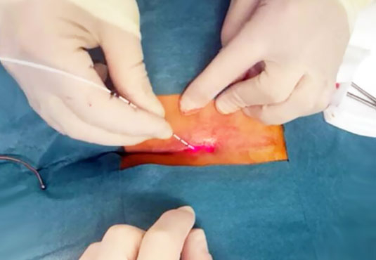 Pilonidalsinus-Laserbehandlung