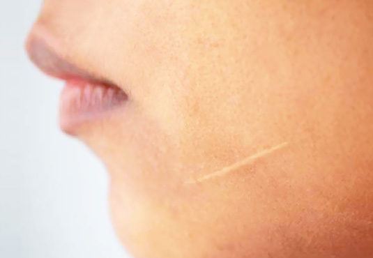 Scar Treatment Turkey