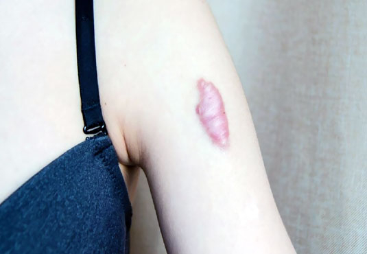 Can keloids turn into cancer?