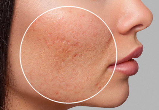 How to get rid of acne scars?