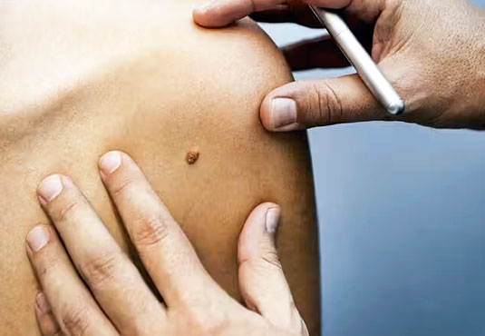 Is it harmful to have moles removed?