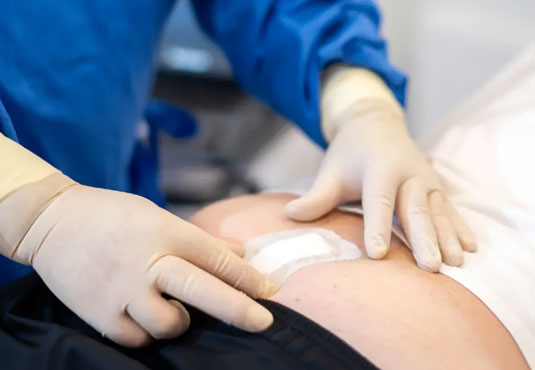 Operation oder Laserbehandlung bei eingewachsenen Haaren?