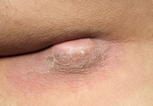 Pilonidalsinus-Abszess-Drainage